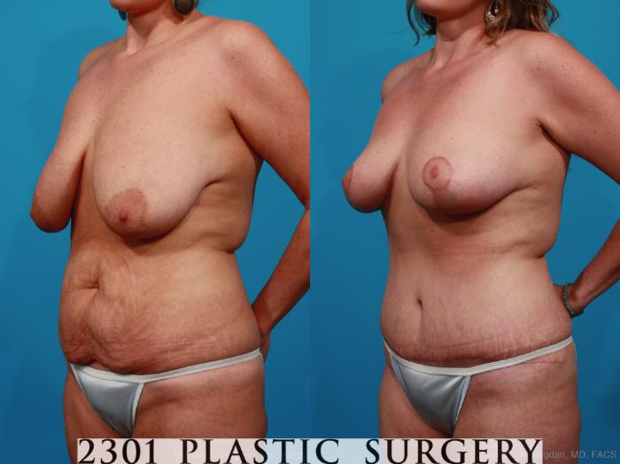Before & After Breast Reduction Case 282 View #3 View in Fort Worth, Plano, & Frisco, Texas