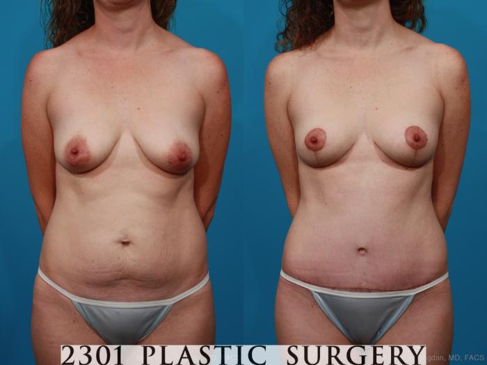 Before & After Breast Lift (Mastopexy) Case 284 View #1 View in Fort Worth, Plano, & Frisco, Texas