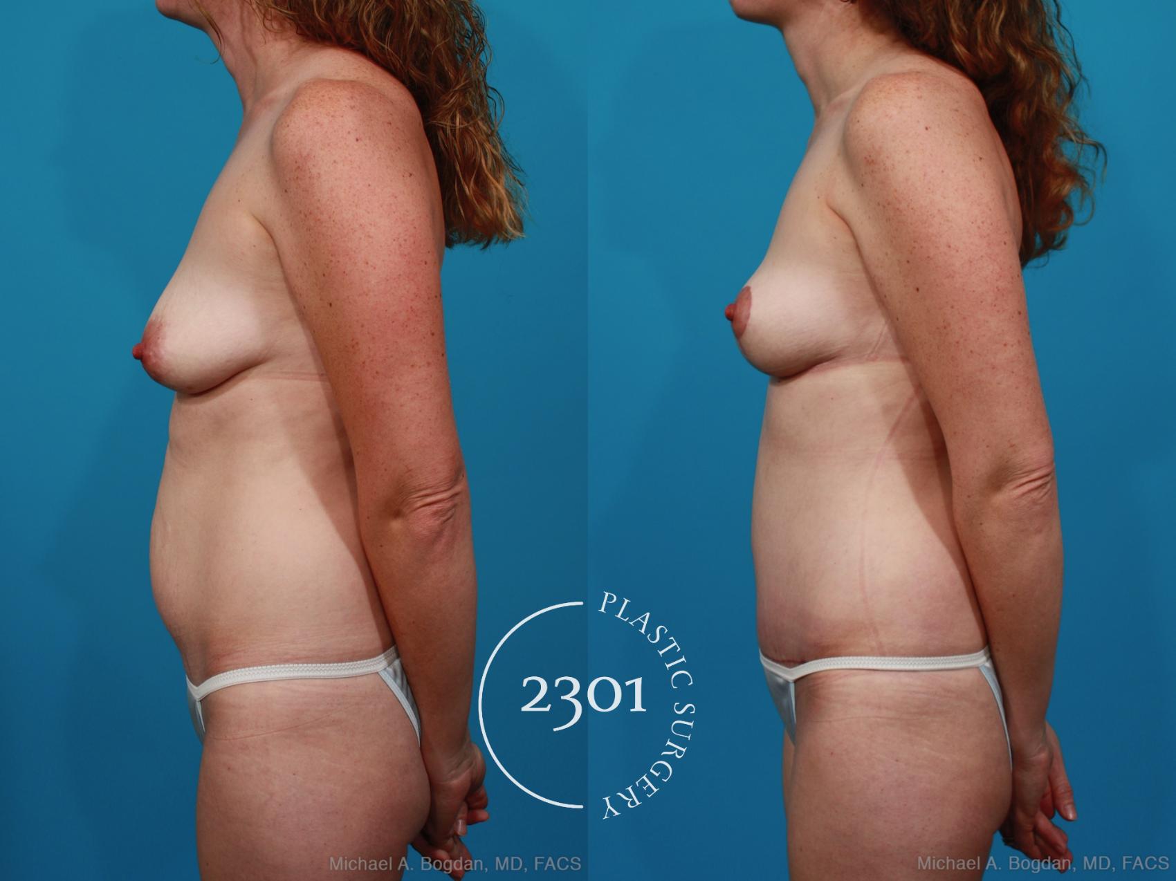 Before & After Mommy Makeover Case 284 View #2 View in Fort Worth, Plano, & Frisco, Texas