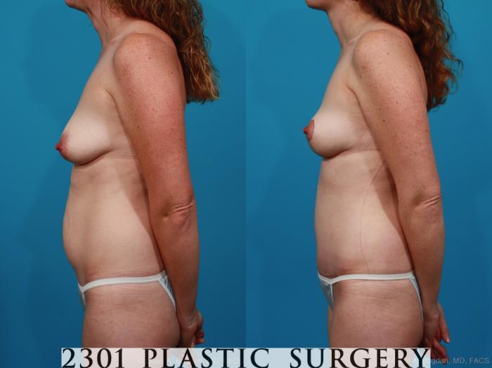 Before & After Breast Lift (Mastopexy) Case 284 View #2 View in Fort Worth, Plano, & Frisco, Texas