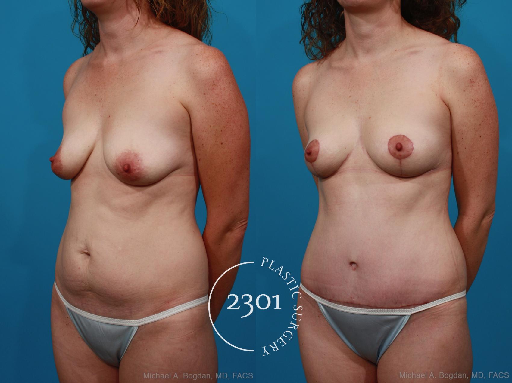 Before & After Mommy Makeover Case 284 View #3 View in Fort Worth, Plano, & Frisco, Texas