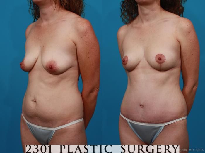 Before & After Mommy Makeover Case 284 View #3 View in Fort Worth, Plano, & Frisco, Texas