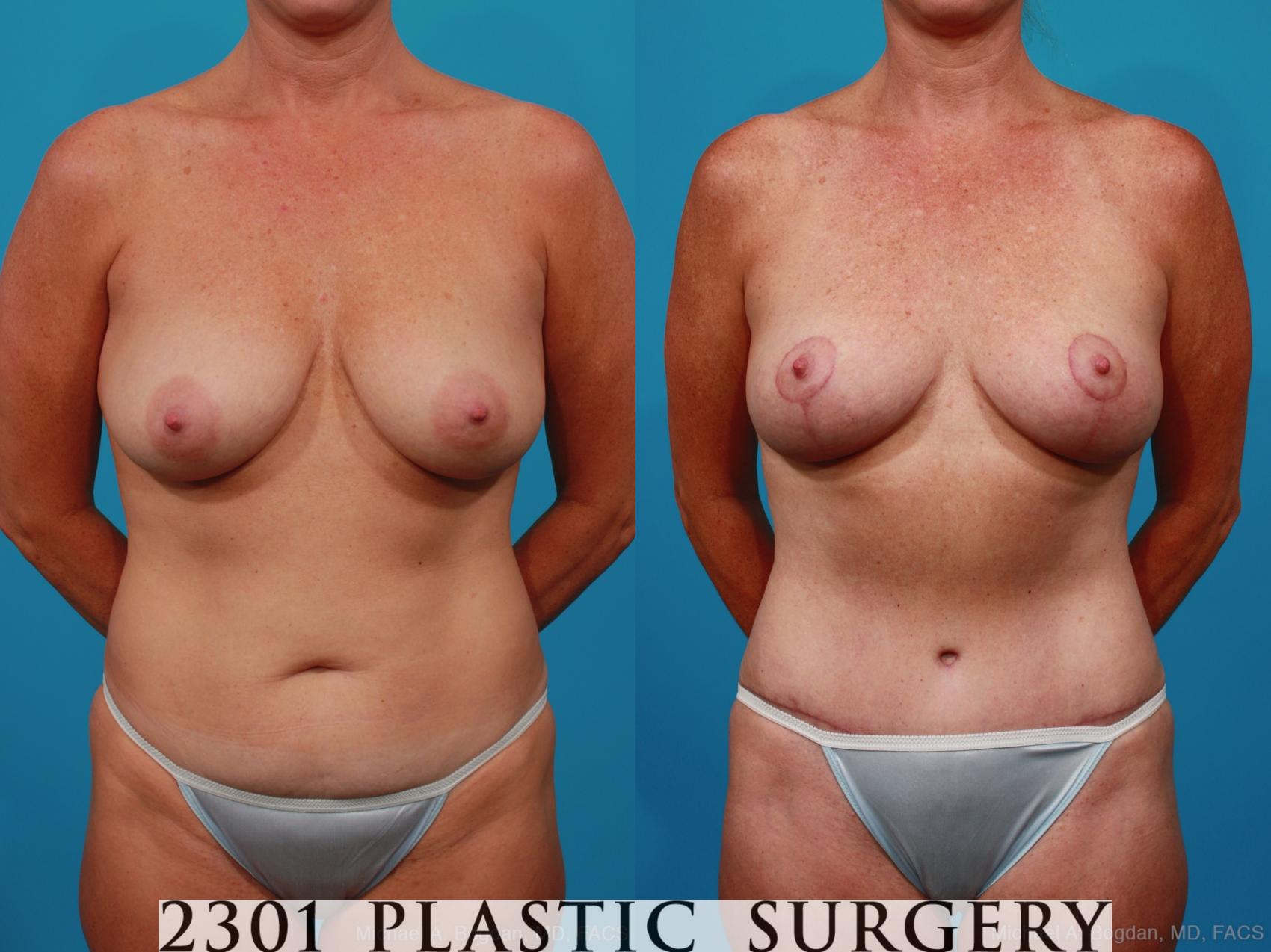 Before & After Tummy Tuck Case 289 View #1 View in Fort Worth, Plano, & Frisco, Texas