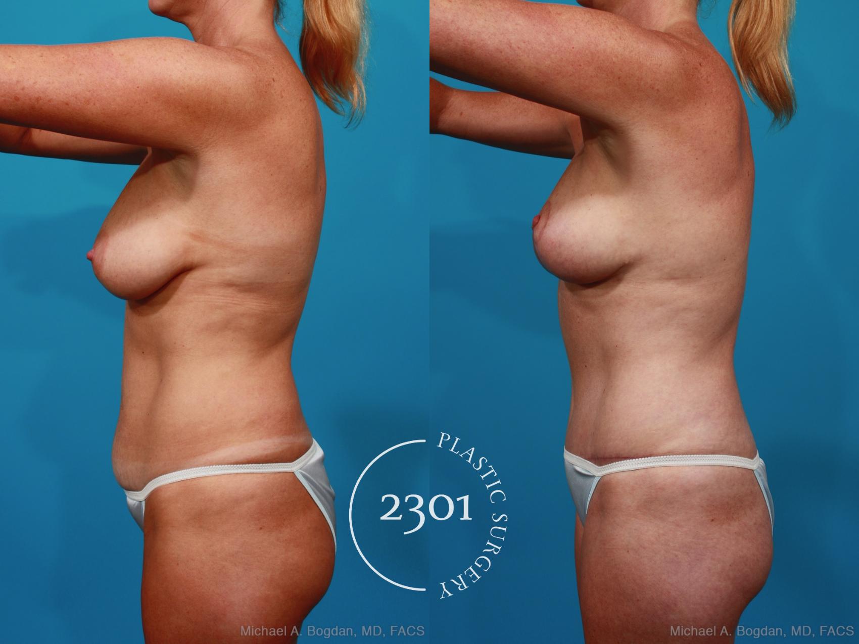 Before & After Tummy Tuck Case 289 View #2 View in Fort Worth, Plano, & Frisco, Texas