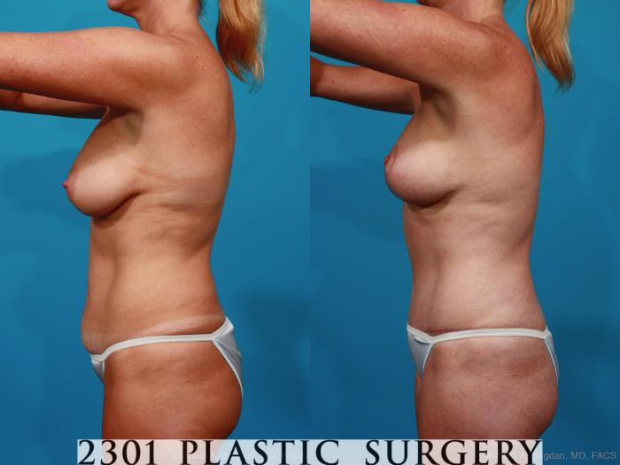 Before & After Tummy Tuck Case 289 View #2 View in Fort Worth, Plano, & Frisco, Texas