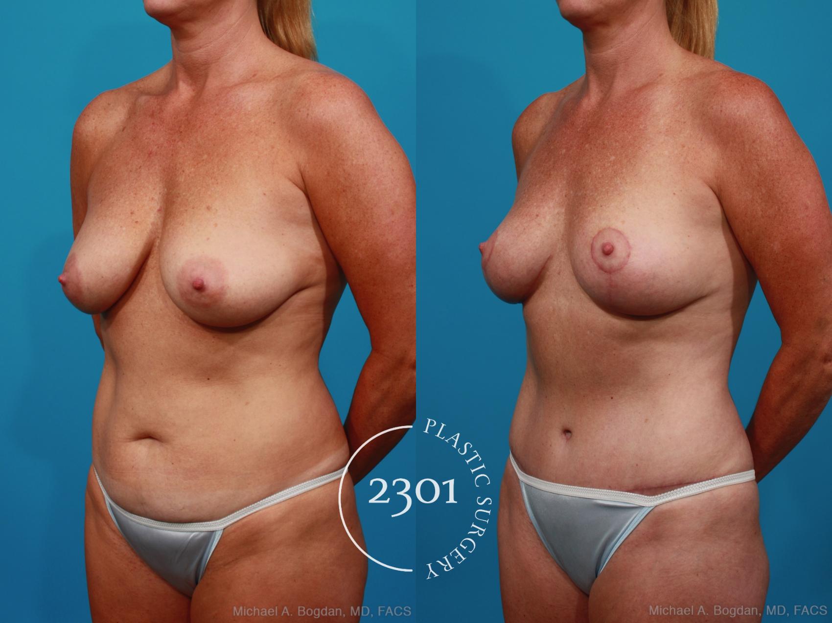 Before & After Tummy Tuck Case 289 View #3 View in Fort Worth, Plano, & Frisco, Texas