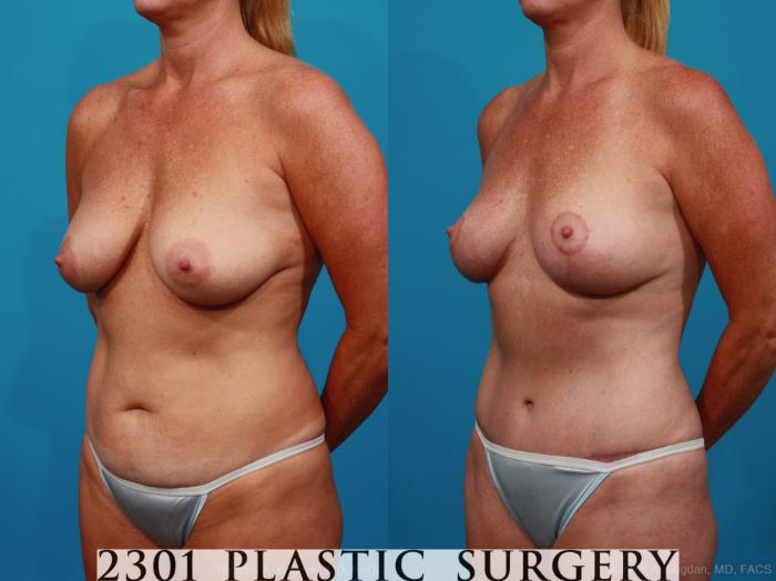 Before & After Breast Lift (Mastopexy) Case 289 View #3 View in Fort Worth, Plano, & Frisco, Texas