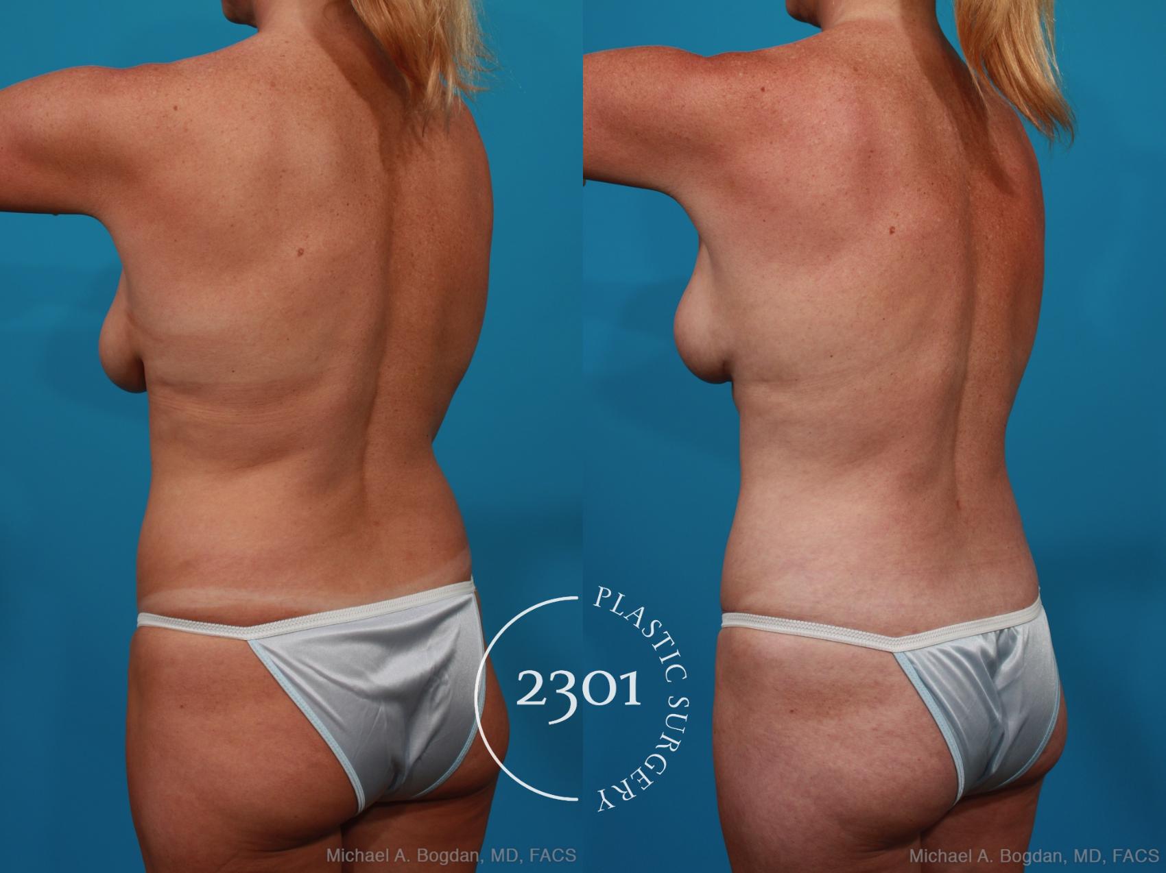 Before & After Tummy Tuck Case 289 View #4 View in Fort Worth, Plano, & Frisco, Texas