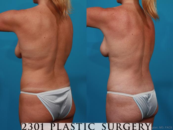 Before & After Breast Lift (Mastopexy) Case 289 View #4 View in Fort Worth, Plano, & Frisco, Texas