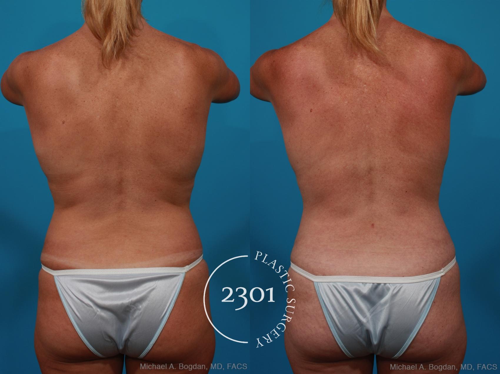 Before & After Tummy Tuck Case 289 View #5 View in Fort Worth, Plano, & Frisco, Texas