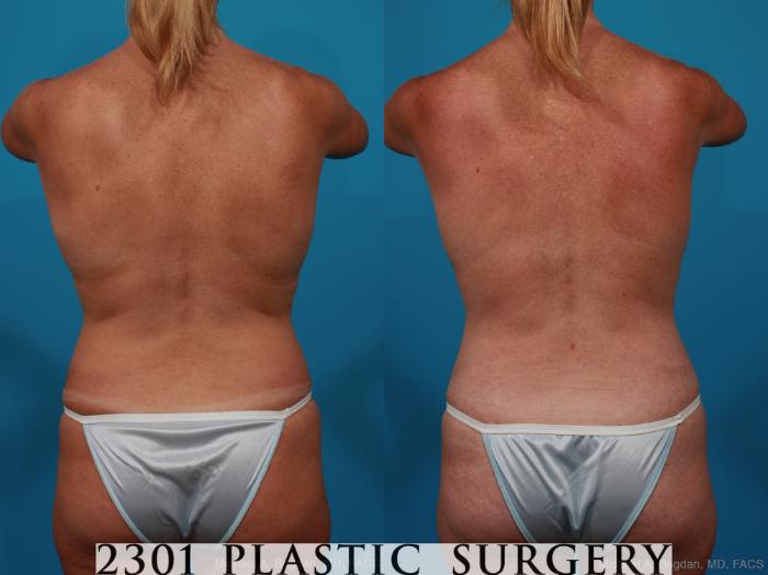 Before & After Tummy Tuck Case 289 View #5 View in Fort Worth, Plano, & Frisco, Texas