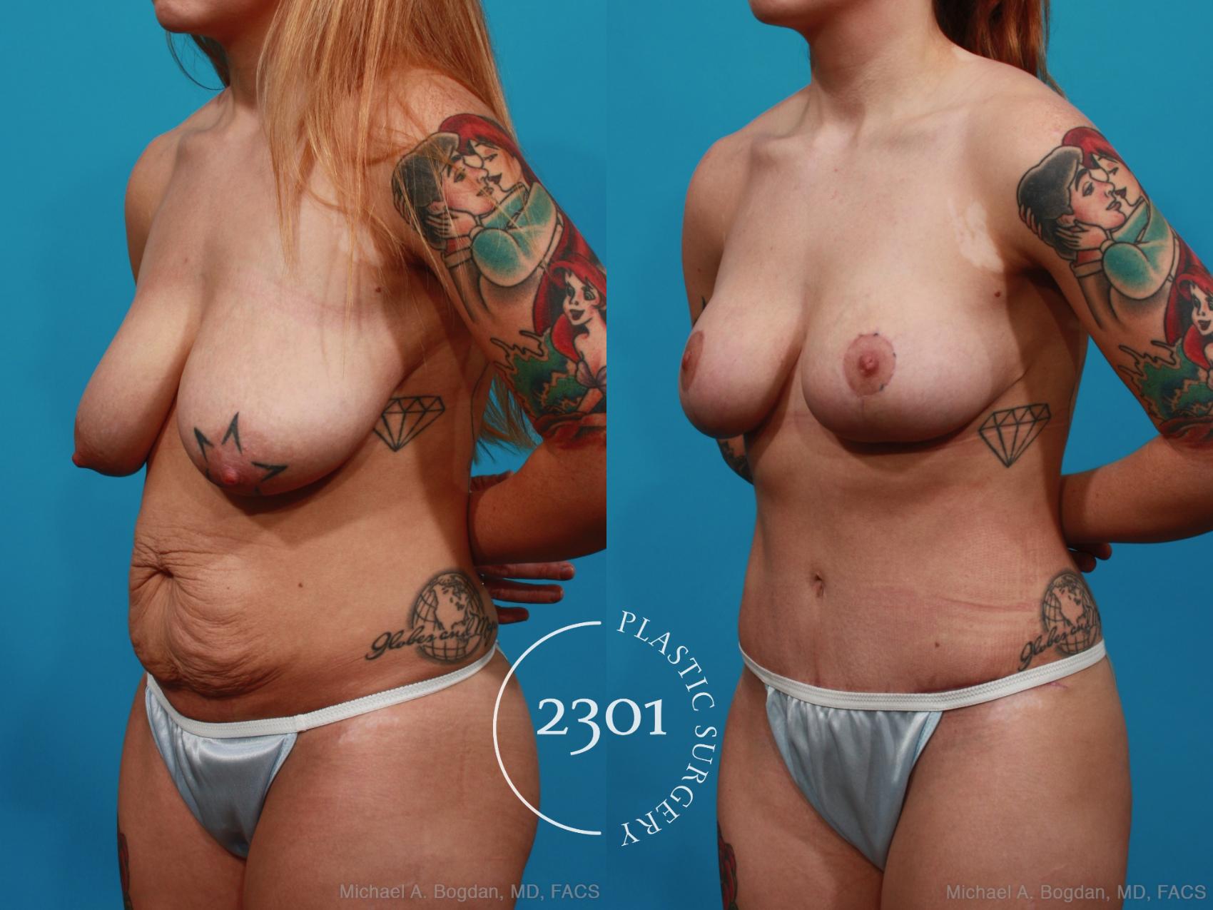 Before & After Mommy Makeover Case 323 View #3 View in Fort Worth, Plano, & Frisco, Texas
