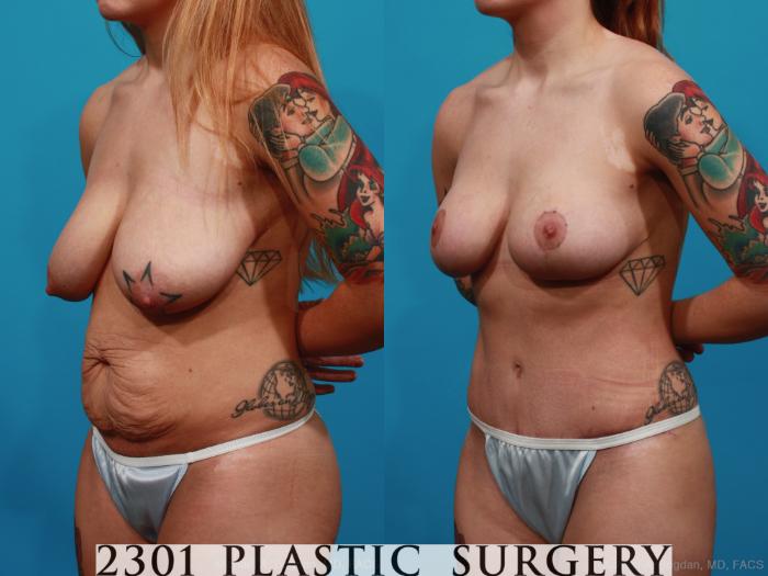 Before & After Mommy Makeover Case 323 View #3 View in Fort Worth & Frisco, Texas