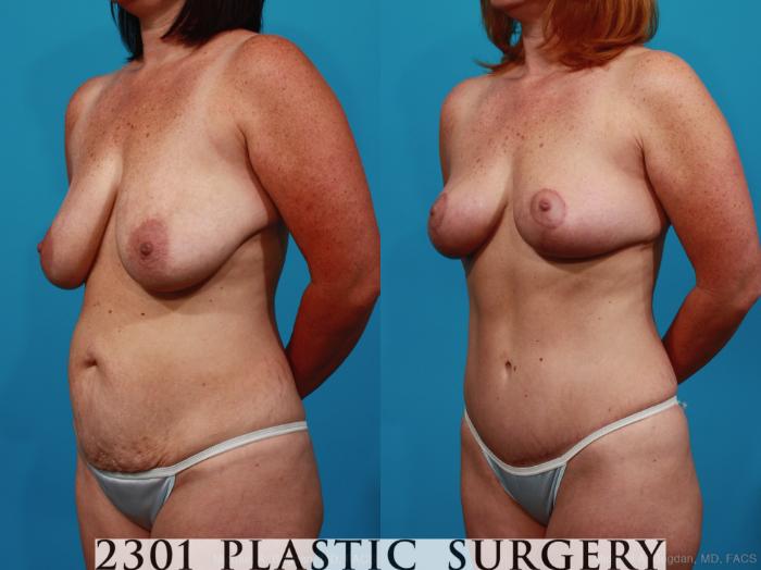 Before & After Mommy Makeover Case 335 View #3 View in Fort Worth, Plano, & Frisco, Texas