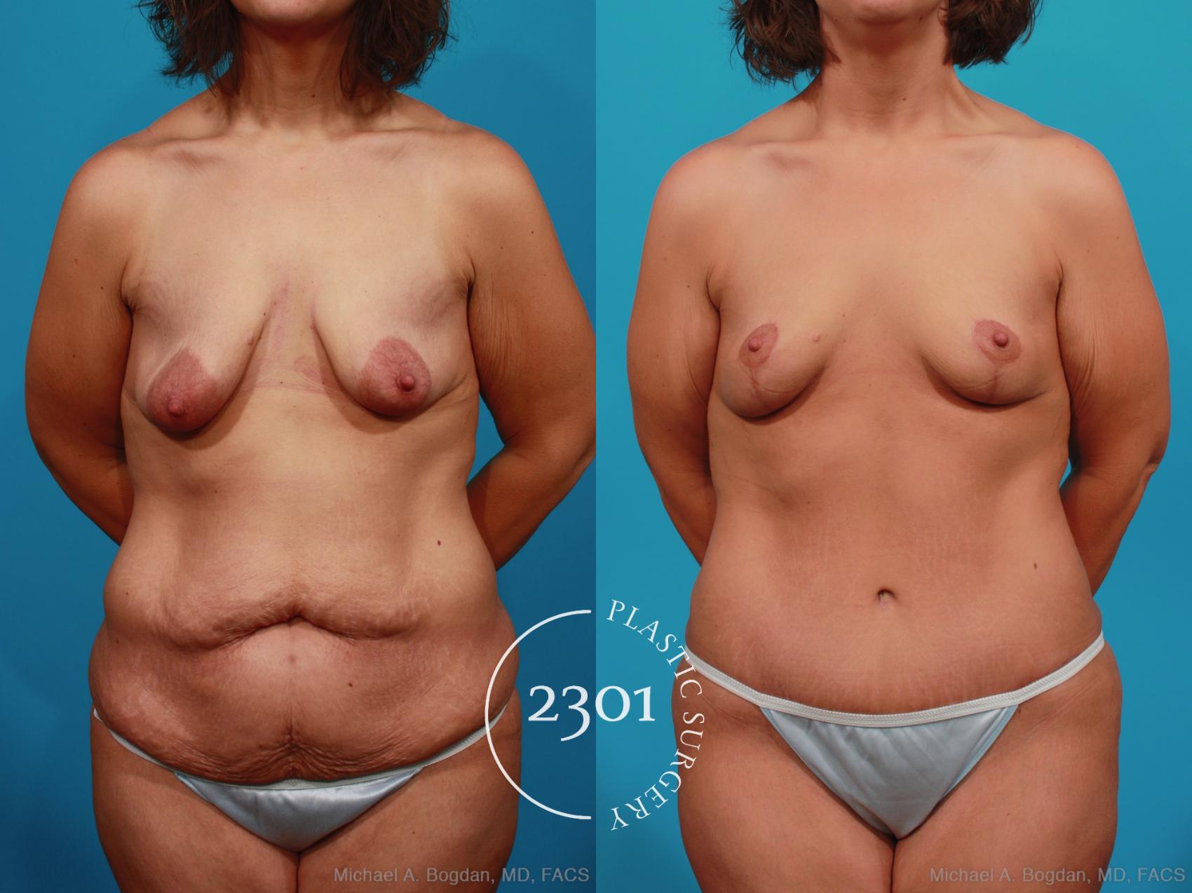 Before & After Breast Lift (Mastopexy) Case 339 View #1 View in Fort Worth, Plano, & Frisco, Texas