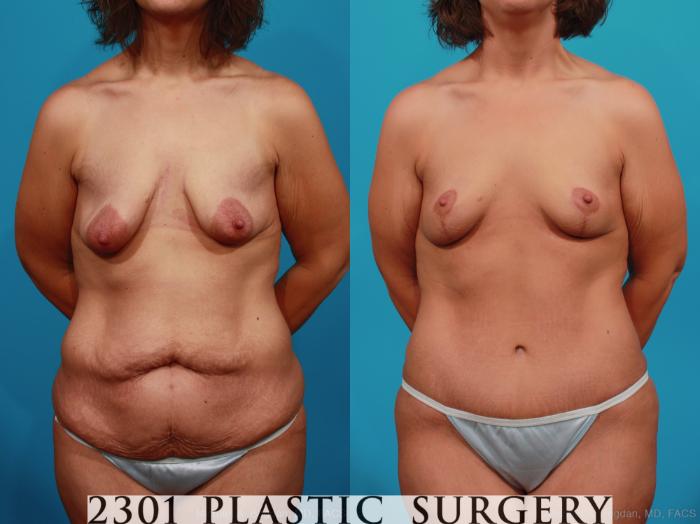 Before & After Breast Lift (Mastopexy) Case 339 View #1 View in Fort Worth, Plano, & Frisco, Texas
