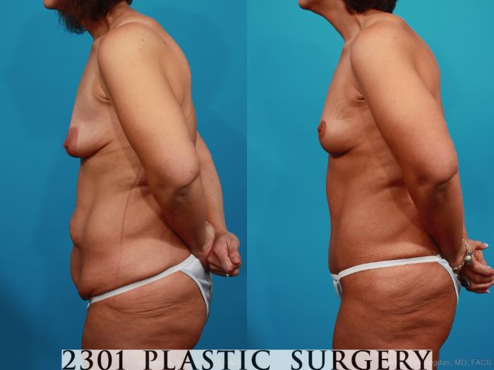 Before & After Breast Lift (Mastopexy) Case 339 View #2 View in Fort Worth, Plano, & Frisco, Texas