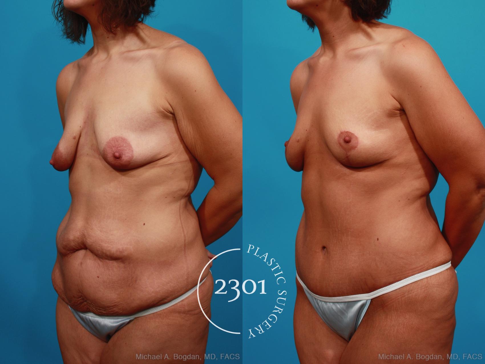 Before & After Mommy Makeover Case 339 View #3 View in Fort Worth, Plano, & Frisco, Texas