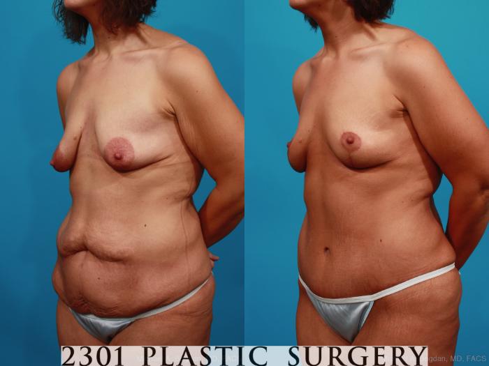 Before & After Breast Lift (Mastopexy) Case 339 View #3 View in Fort Worth, Plano, & Frisco, Texas