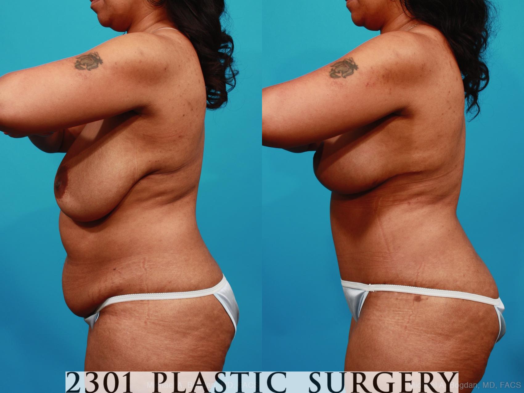 Before & After Mommy Makeover Case 356 View #3 View in Fort Worth & Frisco, Texas