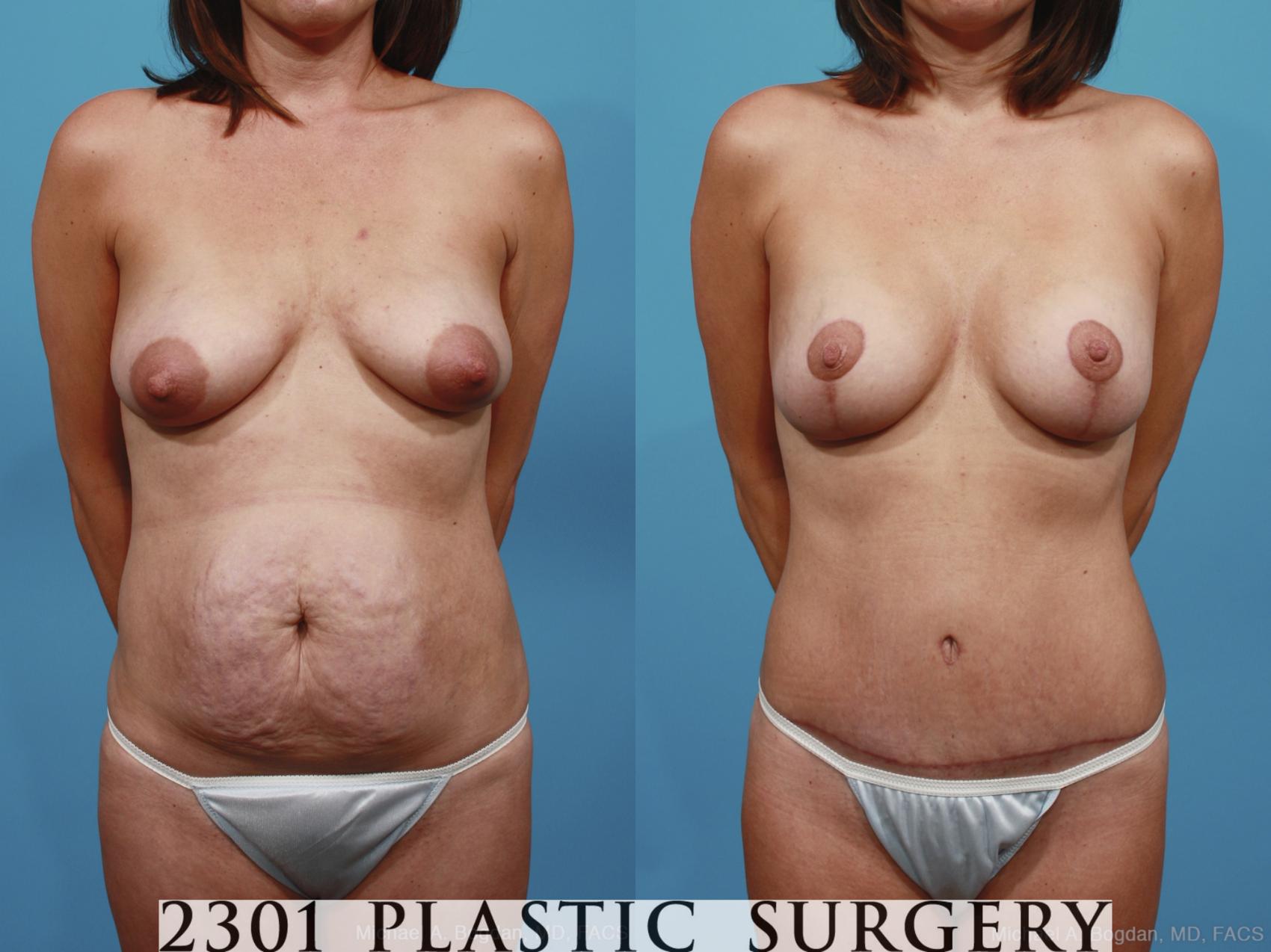 Before & After Tummy Tuck Case 364 View #1 View in Fort Worth, Plano, & Frisco, Texas
