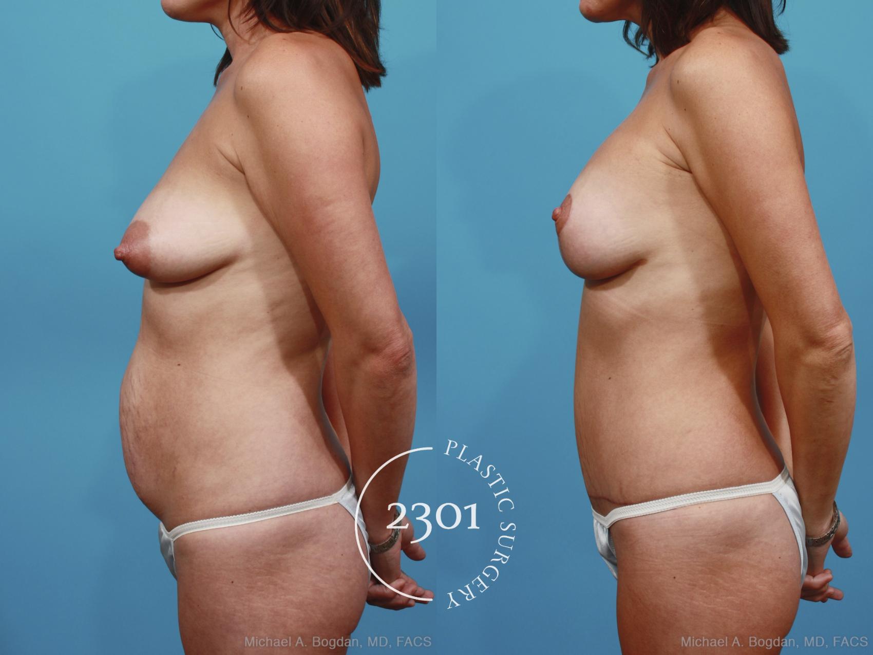 Before & After Silicone Implants Case 364 View #2 View in Fort Worth, Plano, & Frisco, Texas