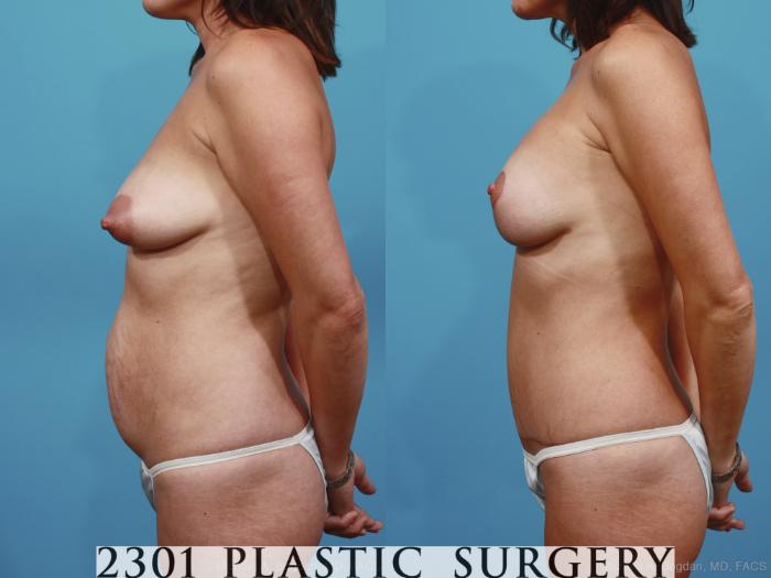 Before & After Mastopexy & Augmentation Case 364 View #2 View in Fort Worth, Plano, & Frisco, Texas