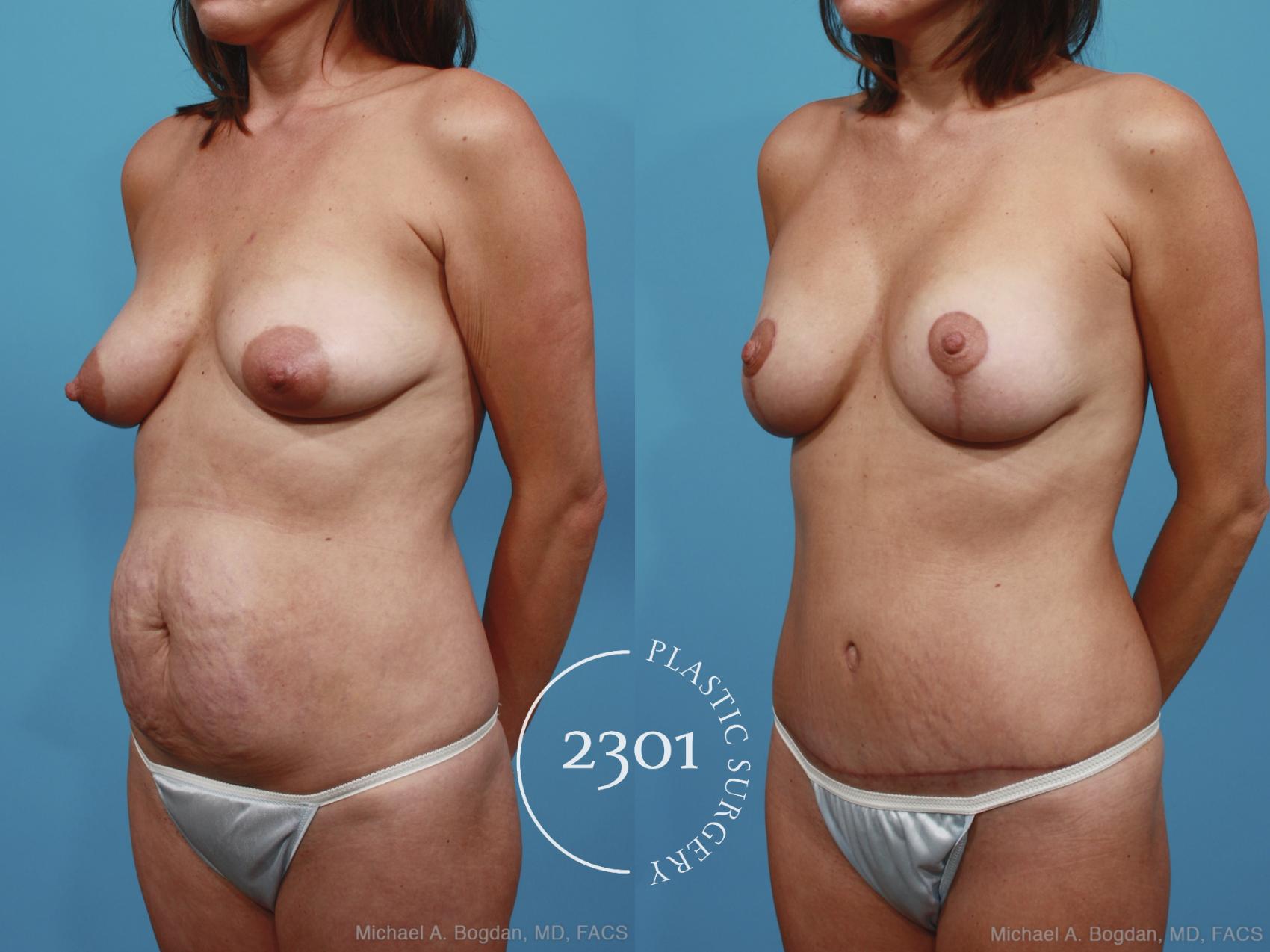 Before & After Silicone Implants Case 364 View #3 View in Fort Worth, Plano, & Frisco, Texas