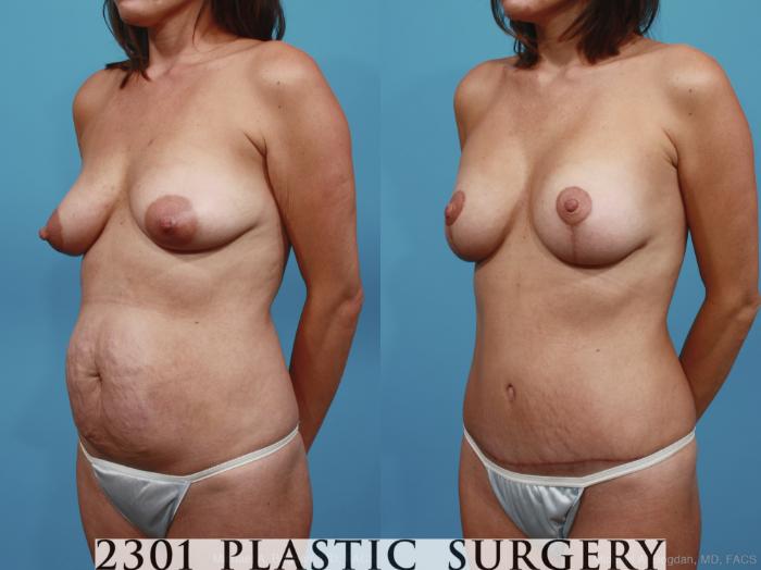 Before & After Mommy Makeover Case 364 View #3 View in Fort Worth, Plano, & Frisco, Texas