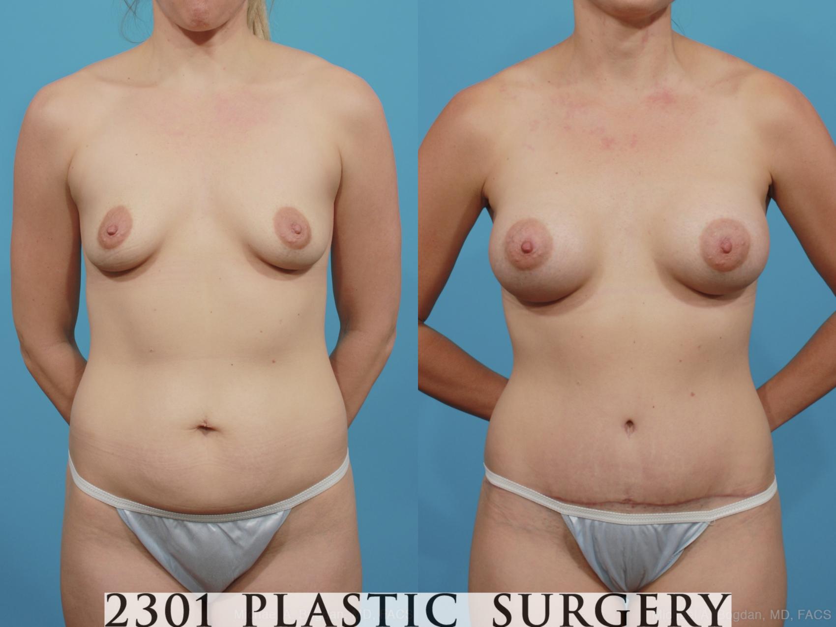 Before & After Breast Augmentation Case 367 View #1 View in Fort Worth, Plano, & Frisco, Texas