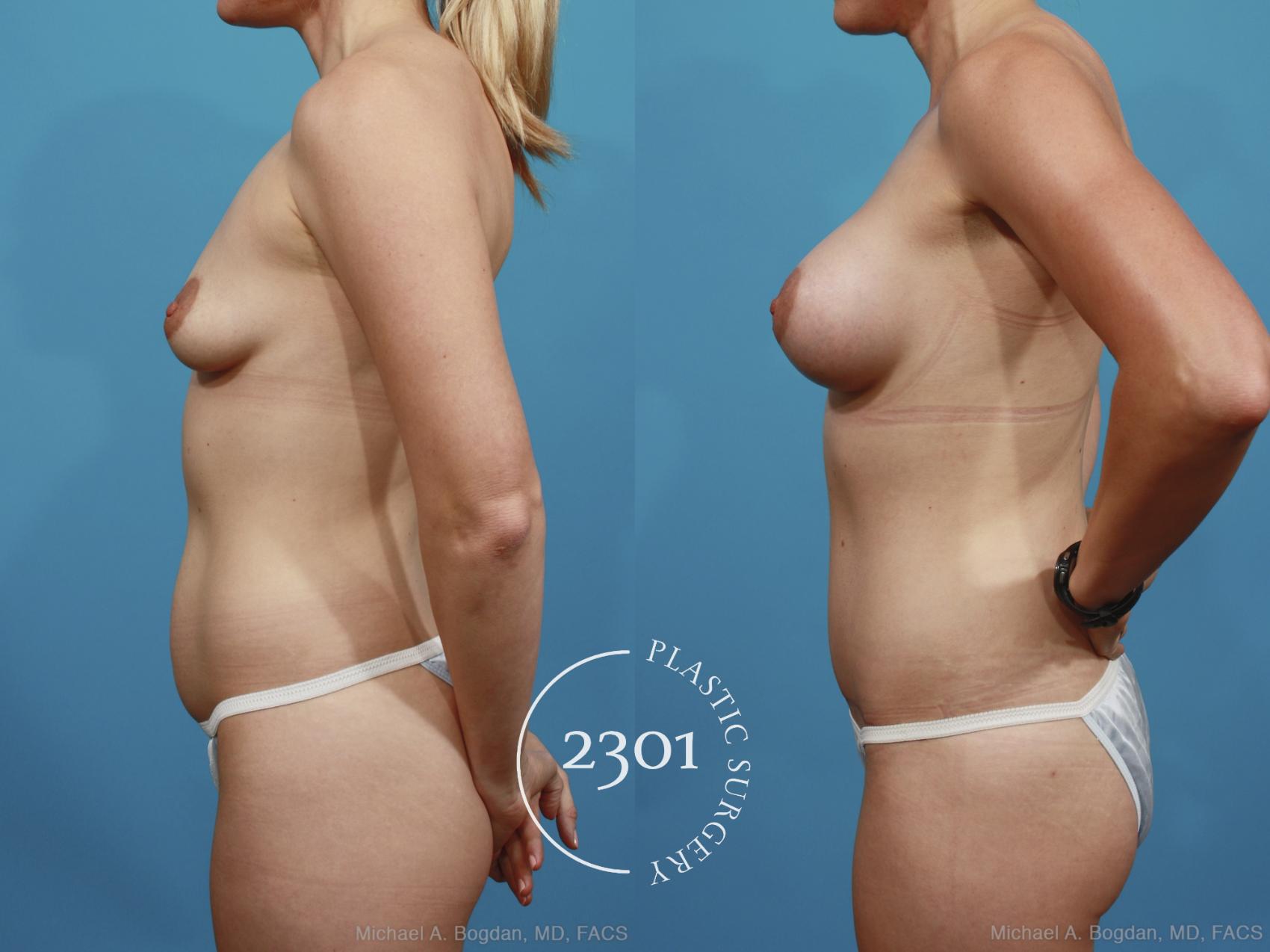 Before & After Silicone Implants Case 367 View #2 View in Fort Worth, Plano, & Frisco, Texas
