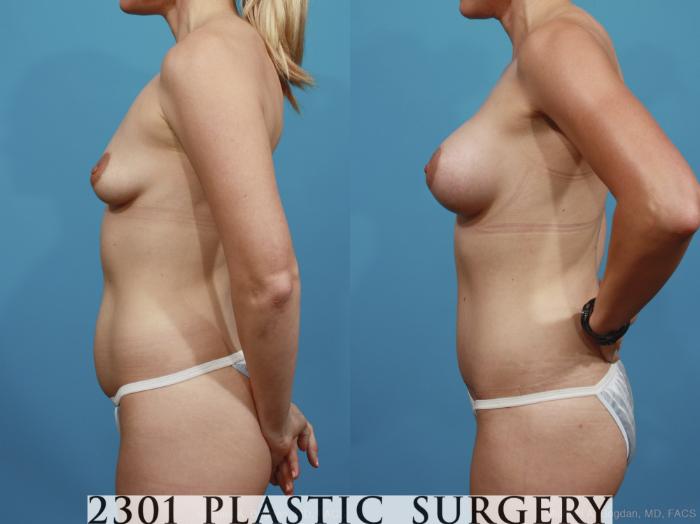 Before & After Silicone Implants Case 367 View #2 View in Fort Worth, Plano, & Frisco, Texas