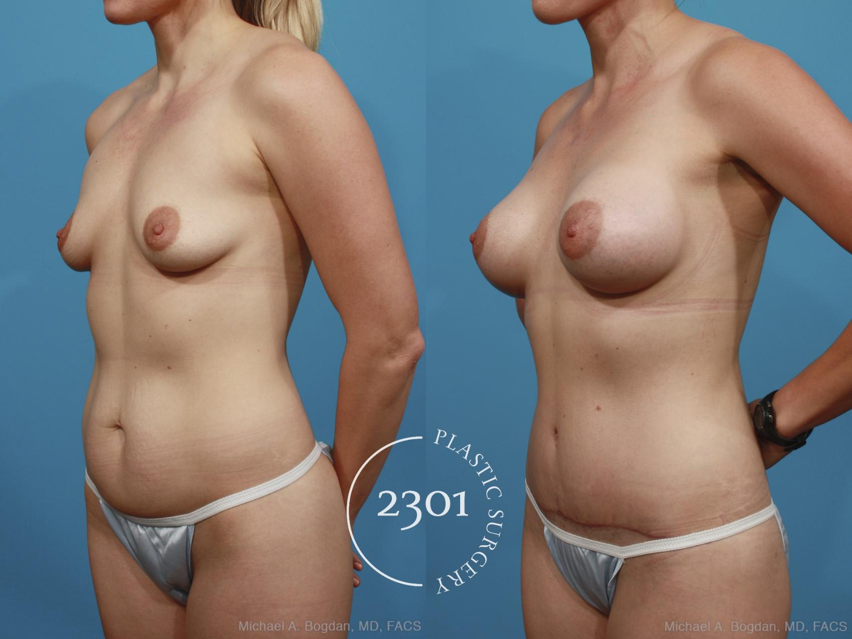 Before & After Silicone Implants Case 367 View #3 View in Fort Worth, Plano, & Frisco, Texas