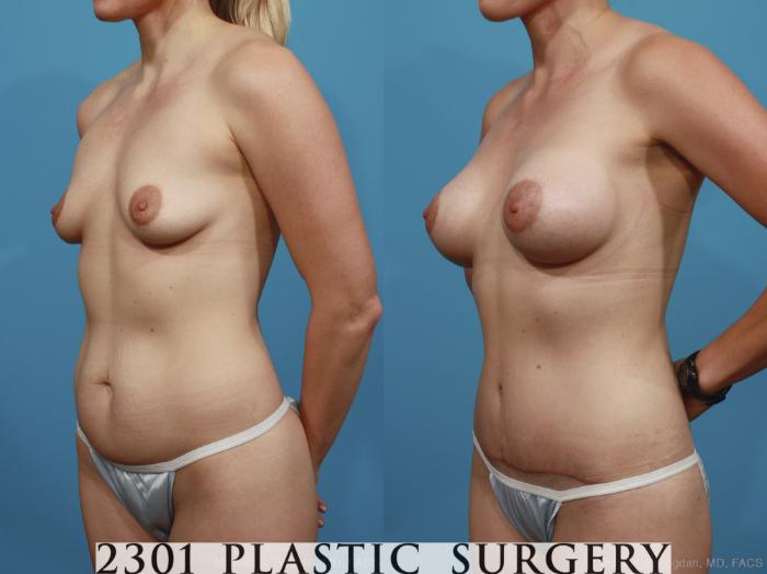 Before & After Mommy Makeover Case 367 View #3 View in Fort Worth, Plano, & Frisco, Texas