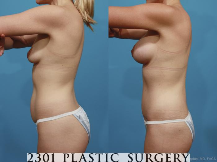 Before & After Silicone Implants Case 367 View #4 View in Fort Worth, Plano, & Frisco, Texas