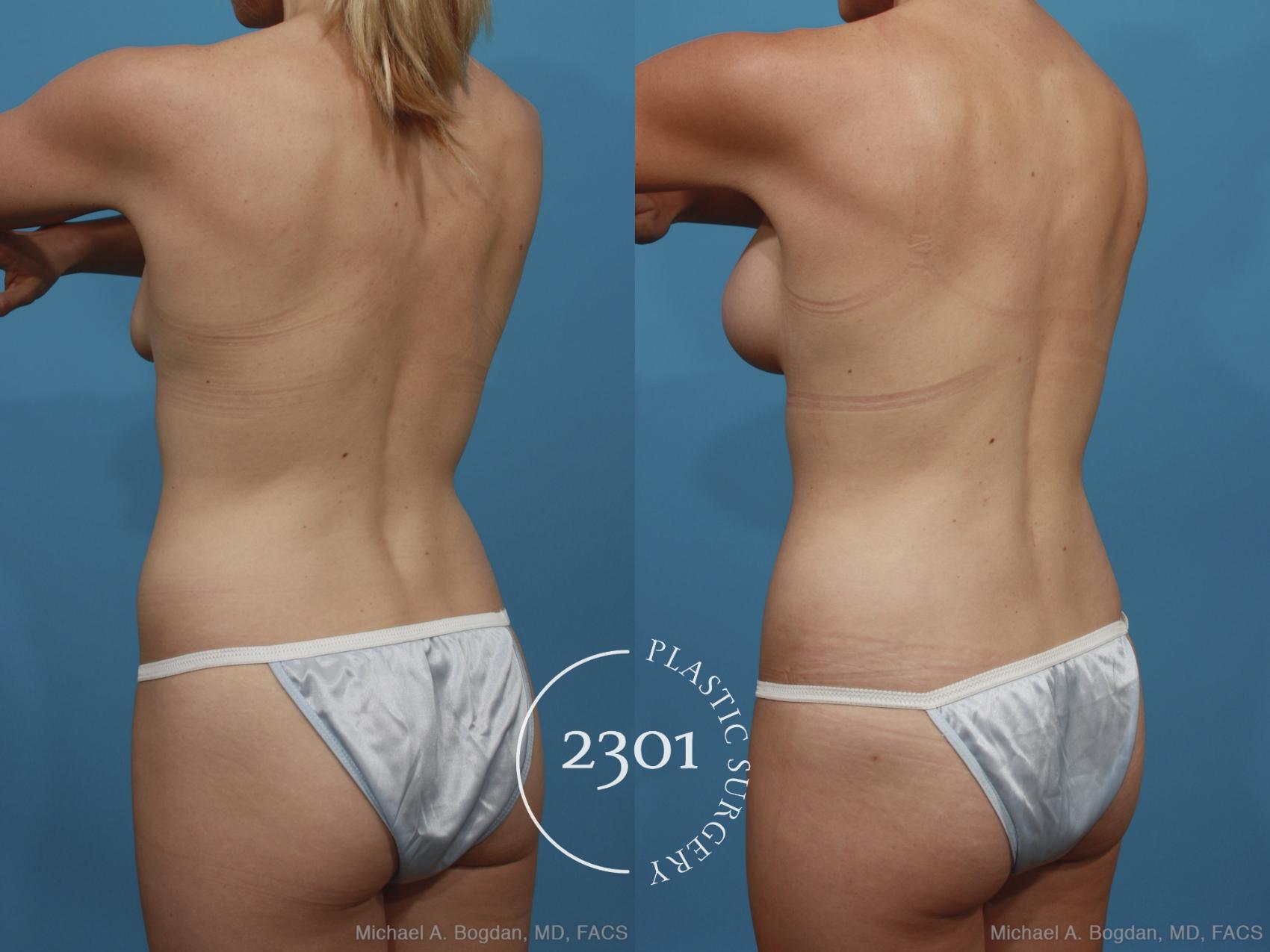 Before & After Silicone Implants Case 367 View #5 View in Fort Worth, Plano, & Frisco, Texas