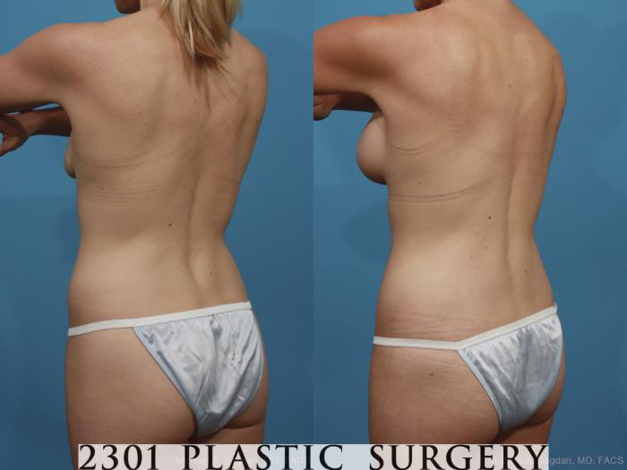 Before & After Breast Augmentation Case 367 View #5 View in Fort Worth, Plano, & Frisco, Texas