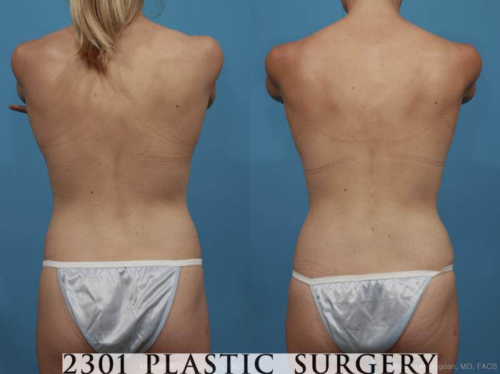 Before & After Breast Augmentation Case 367 View #6 View in Fort Worth, Plano, & Frisco, Texas