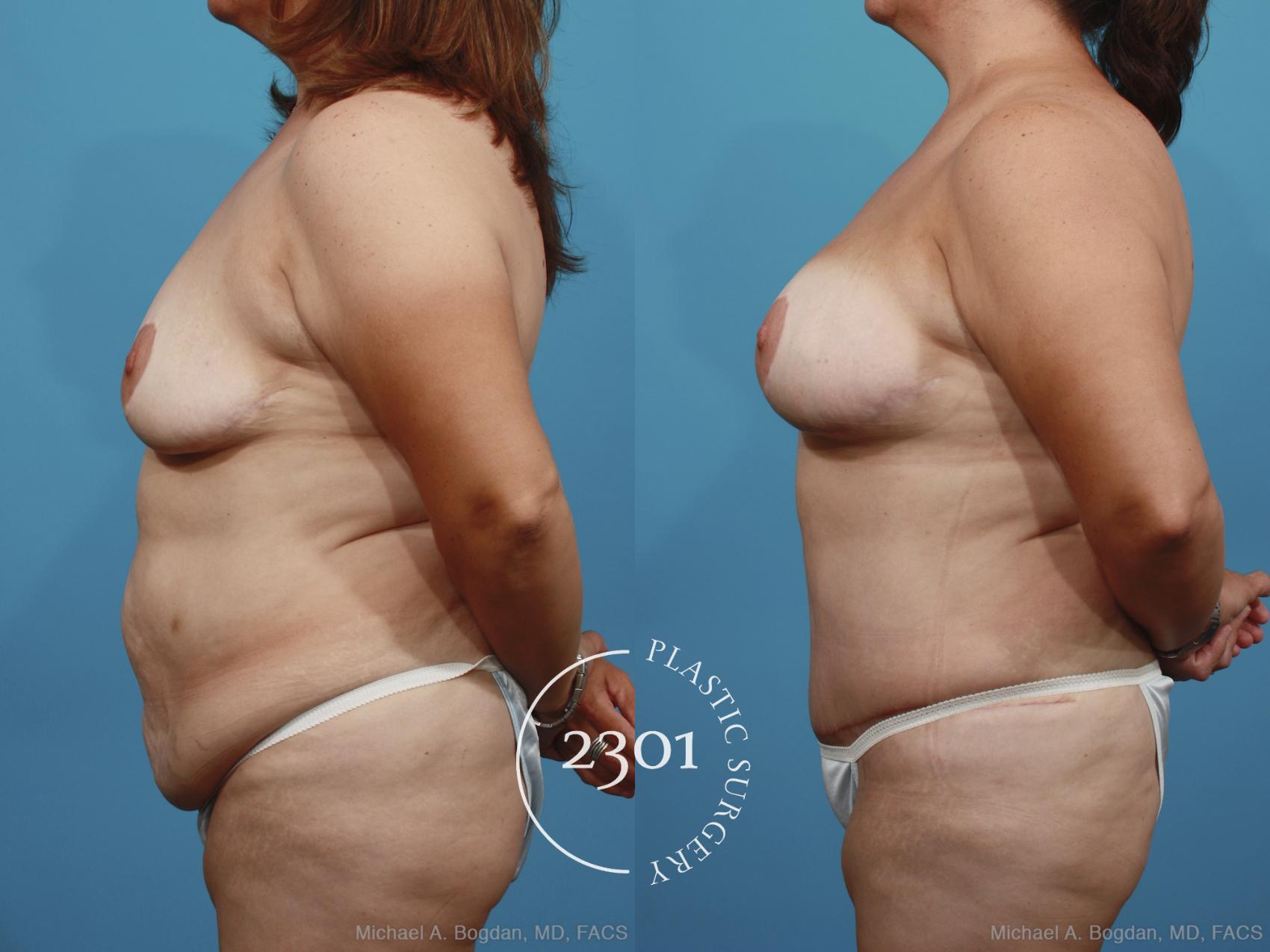 Before & After Mommy Makeover Case 372 View #2 View in Fort Worth, Plano, & Frisco, Texas