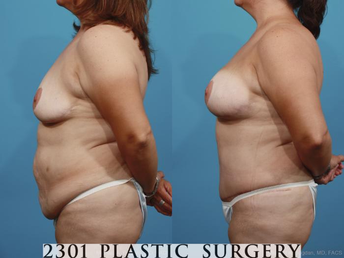 Before & After Mommy Makeover Case 372 View #2 View in Fort Worth, Plano, & Frisco, Texas
