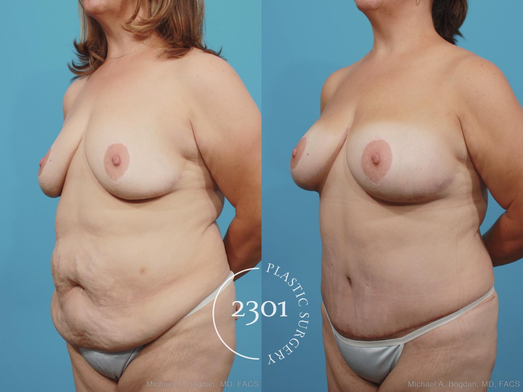 Before & After Mommy Makeover Case 372 View #3 View in Fort Worth, Plano, & Frisco, Texas