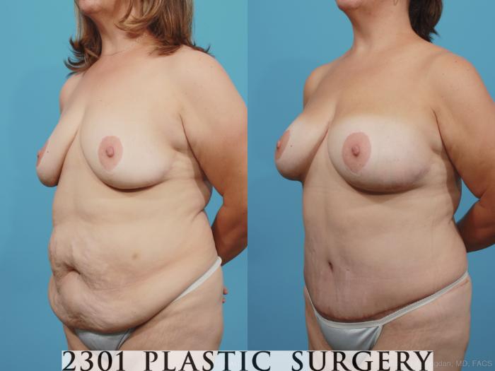 Before & After Mommy Makeover Case 372 View #3 View in Fort Worth, Plano, & Frisco, Texas