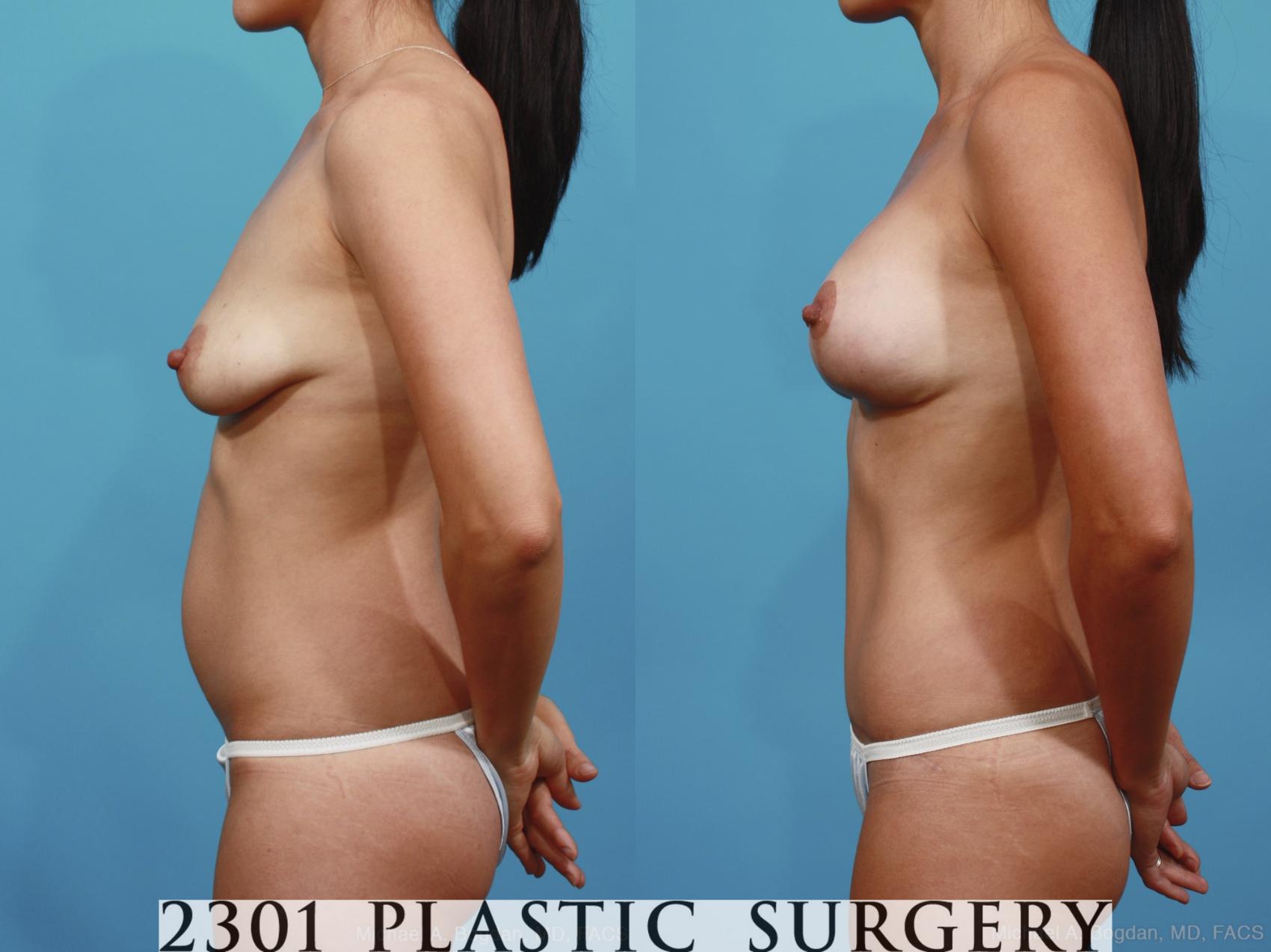 Before & After Mommy Makeover Case 378 View #2 View in Fort Worth & Frisco, Texas