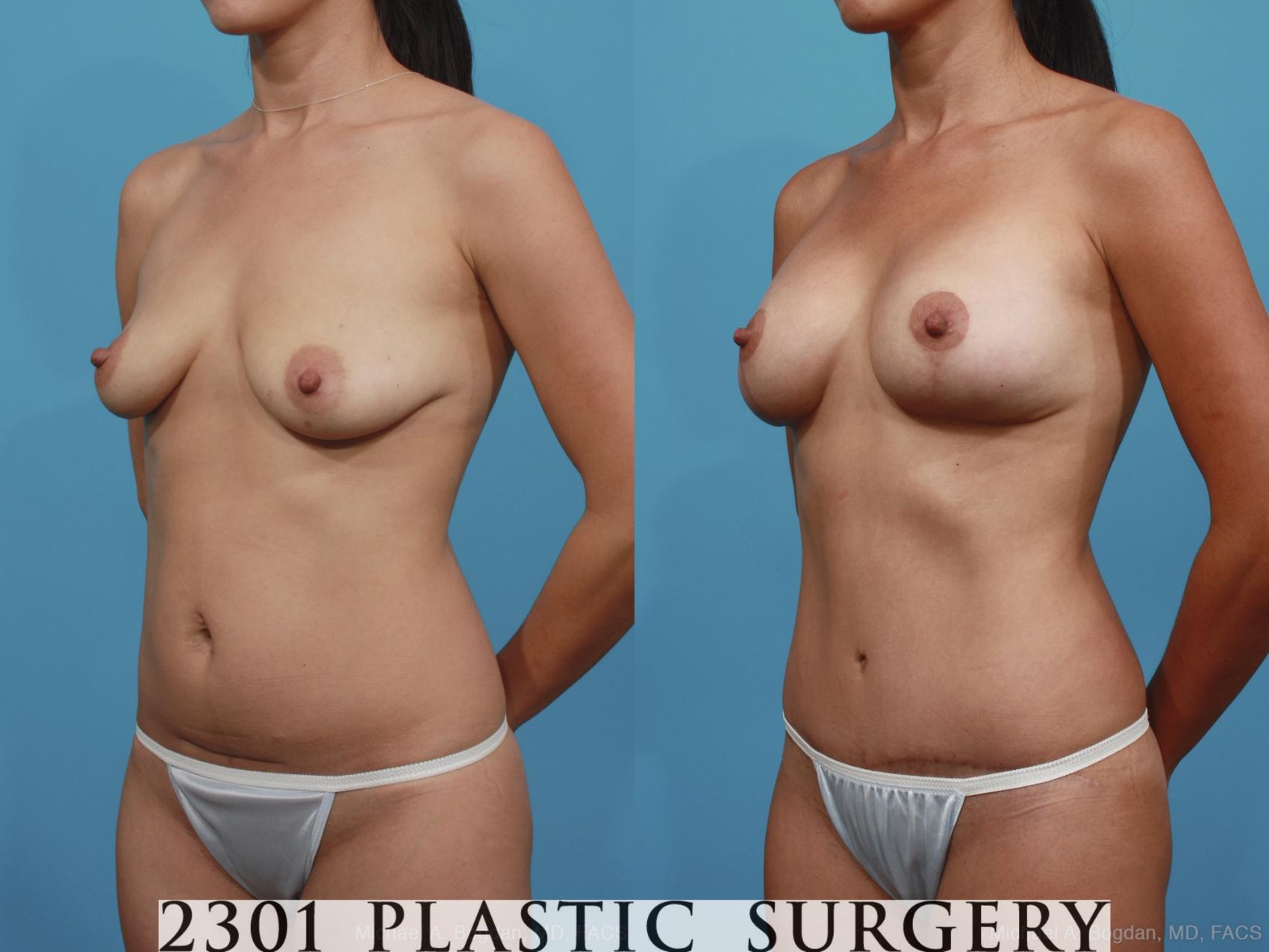 Before & After Mommy Makeover Case 378 View #3 View in Fort Worth & Frisco, Texas