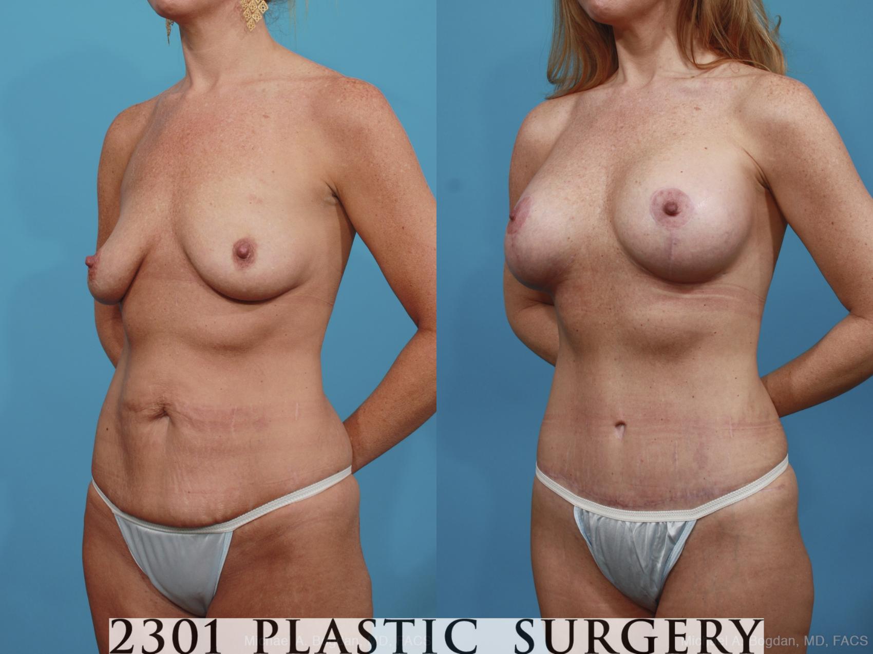 Before & After Mommy Makeover Case 382 View #3 View in Fort Worth & Frisco, Texas