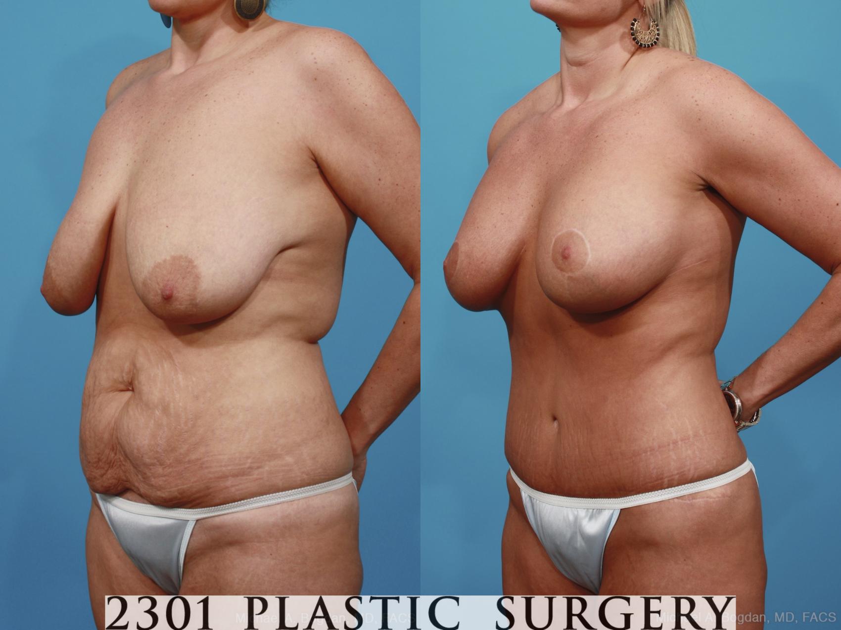 Before & After Mommy Makeover Case 383 View #3 View in Fort Worth & Frisco, Texas