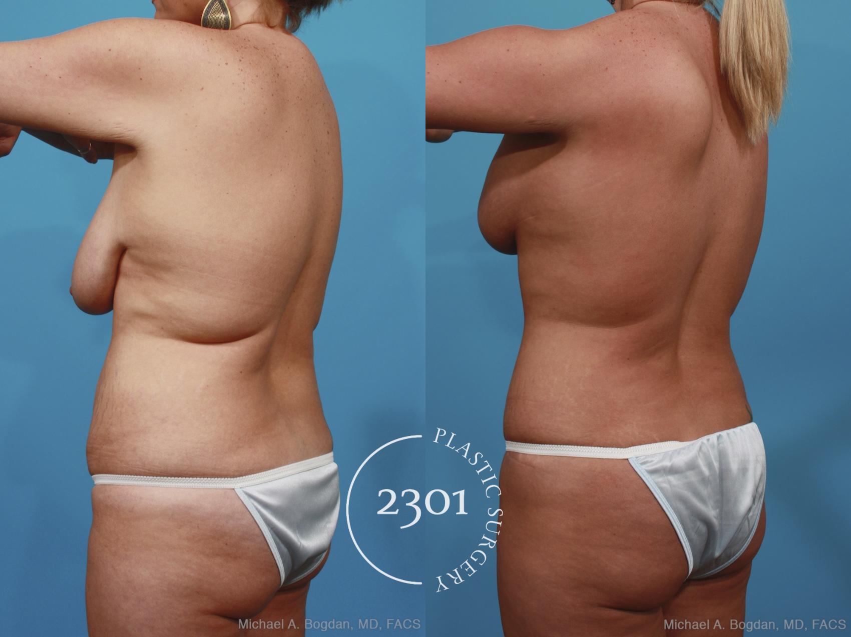 Before & After Mommy Makeover Case 383 View #4 View in Fort Worth, Plano, & Frisco, Texas
