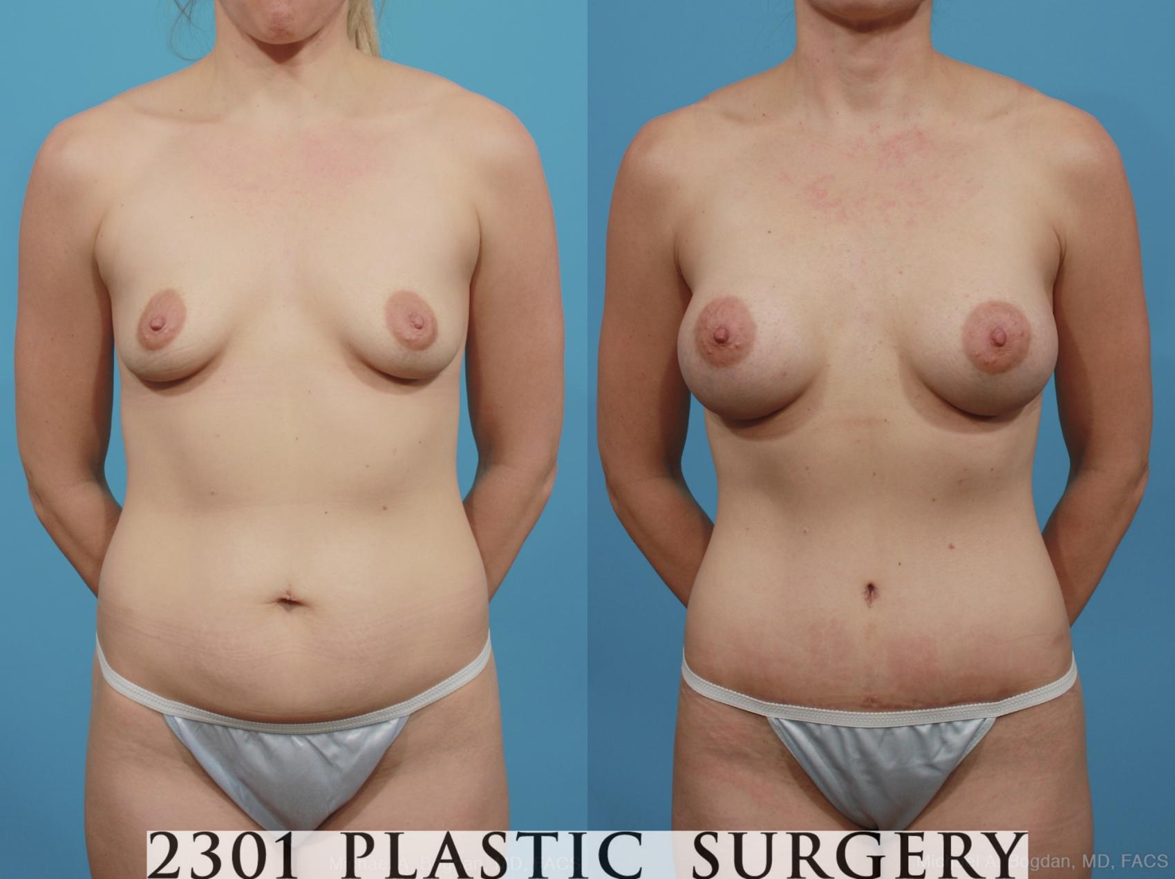 Before & After Silicone Implants Case 386 View #1 View in Fort Worth & Frisco, Texas