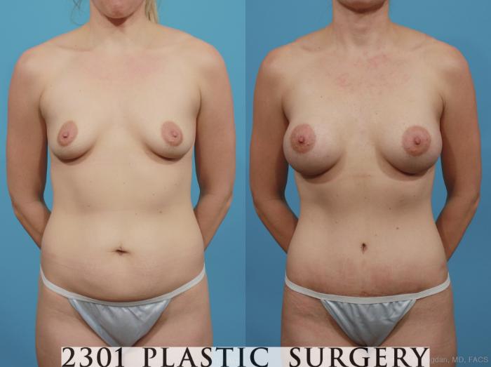 Before & After Breast Augmentation Case 386 View #1 View in Fort Worth, Plano, & Frisco, Texas