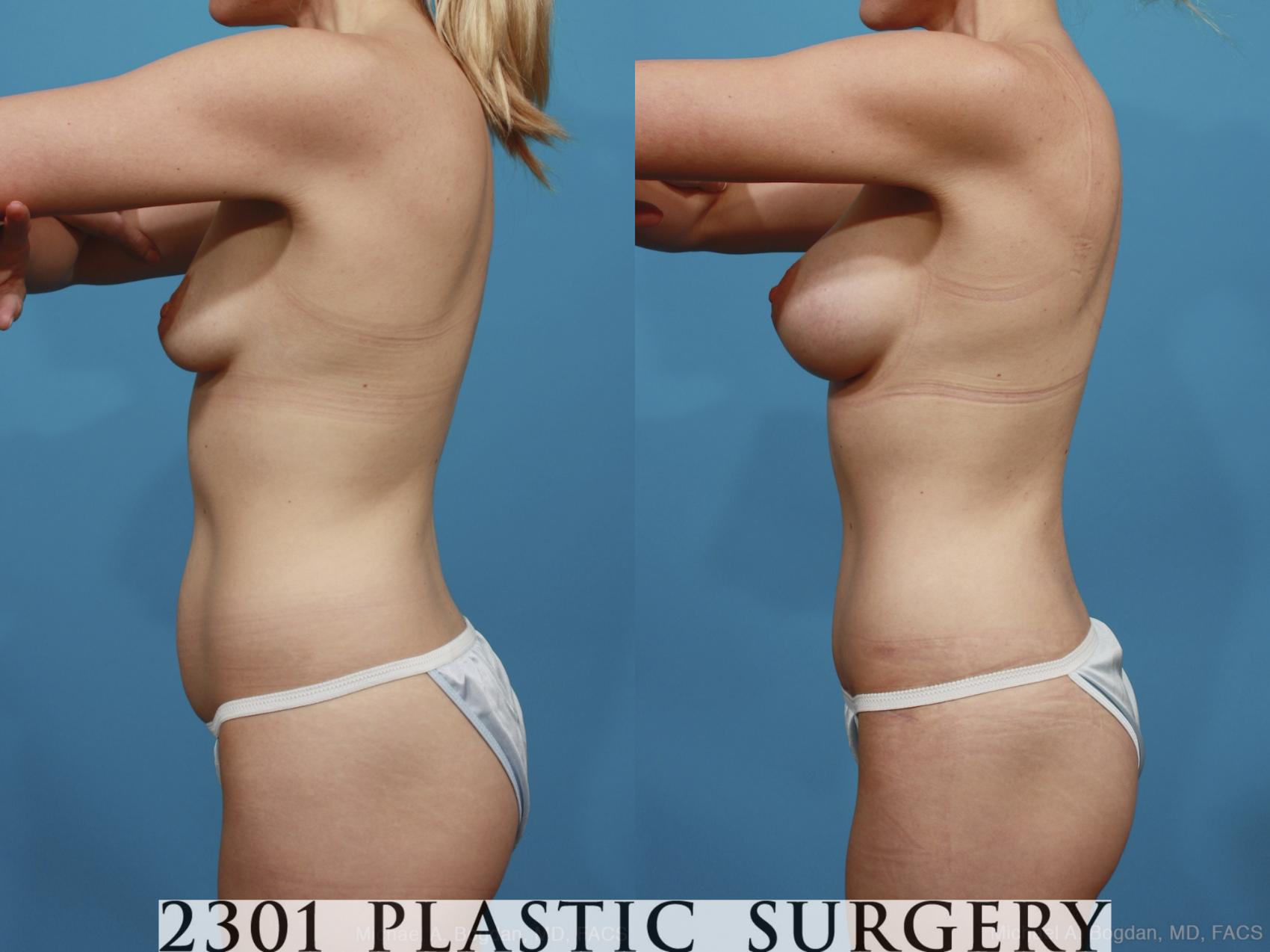 Before & After Silicone Implants Case 386 View #2 View in Fort Worth & Frisco, Texas